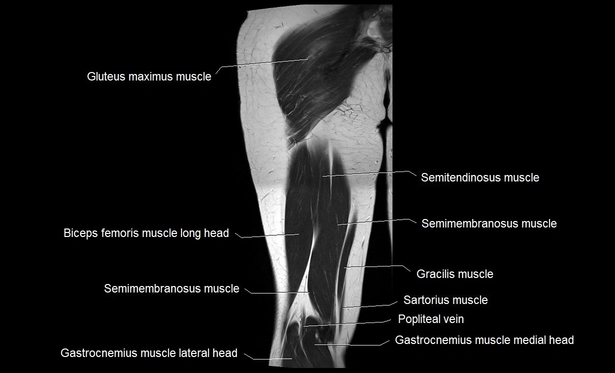 MRI thigh coronal cross sectional anatomy image 19.webp